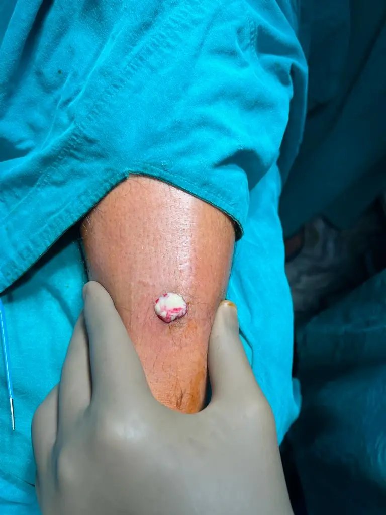 4. Abscess 1
