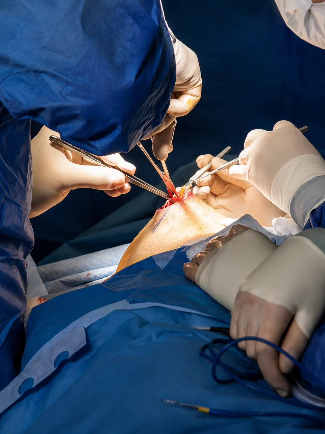 Cancer Surgerie