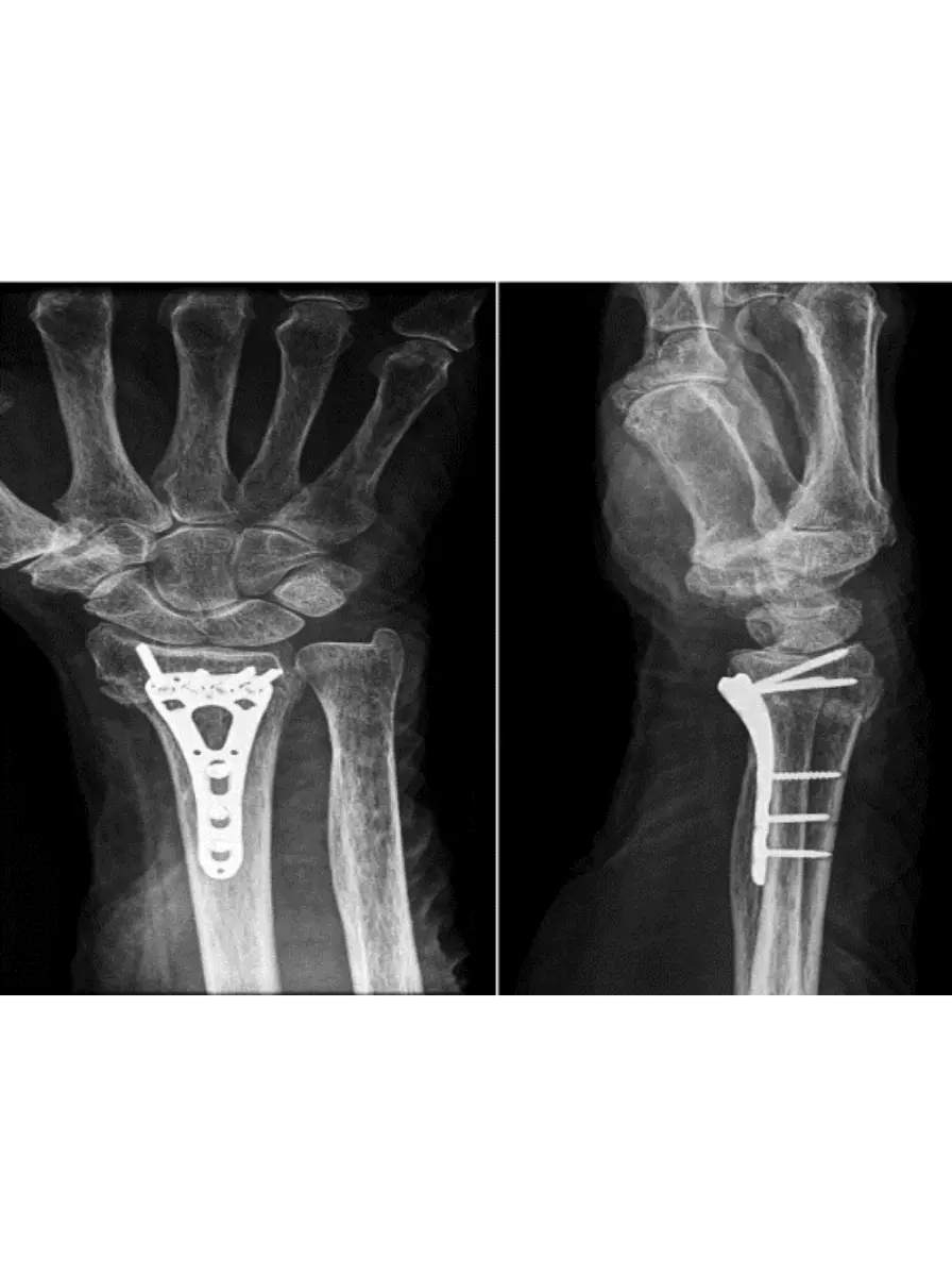 Fracture 1