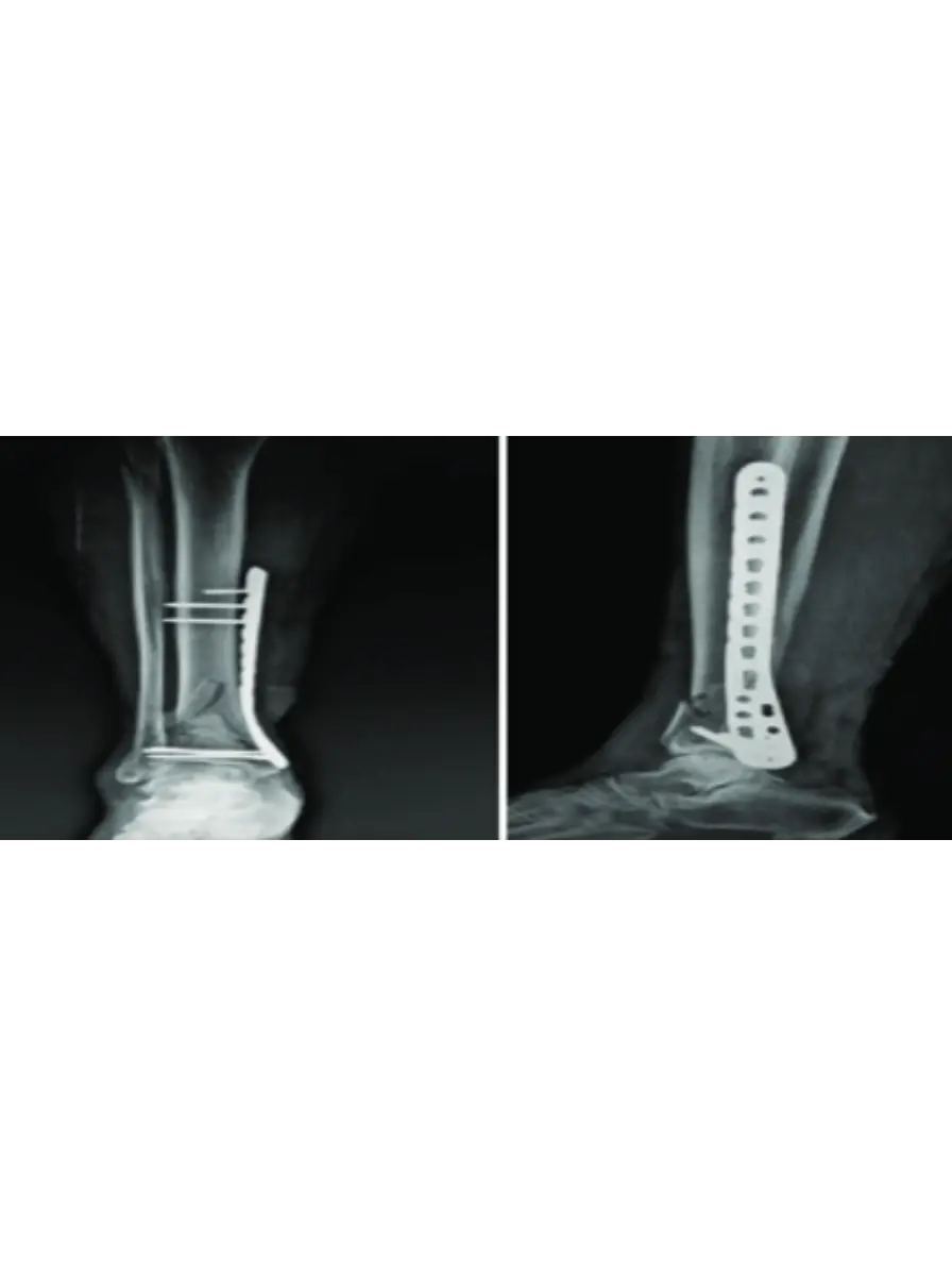 Fracture 2