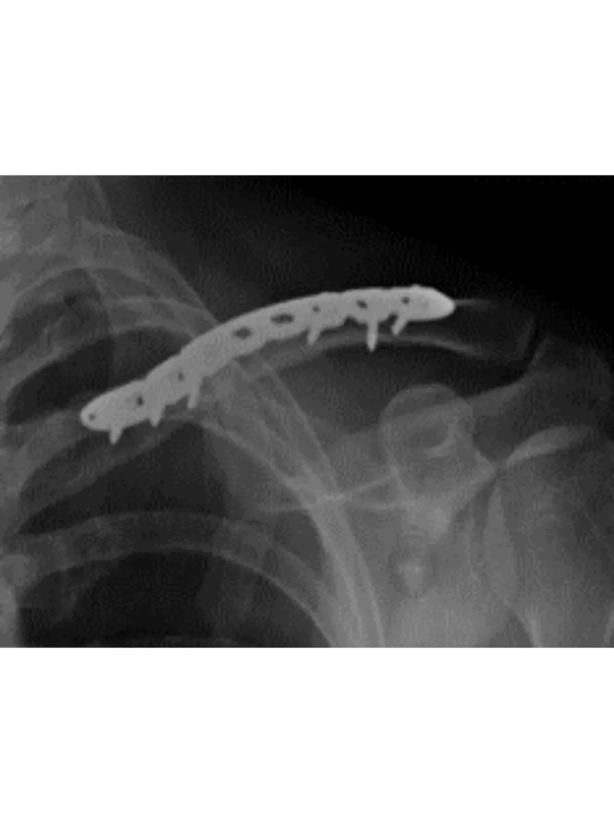 Fracture 3