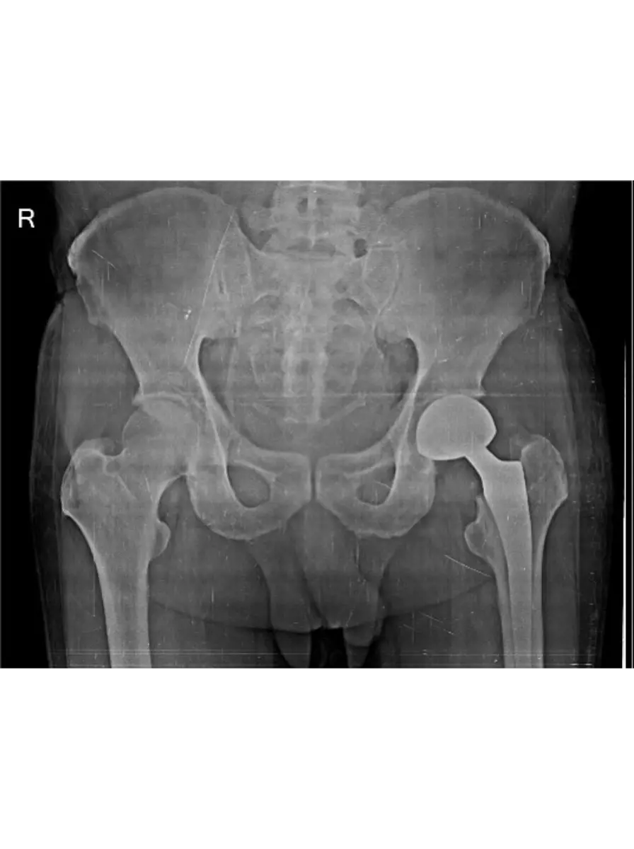Hip Replacement