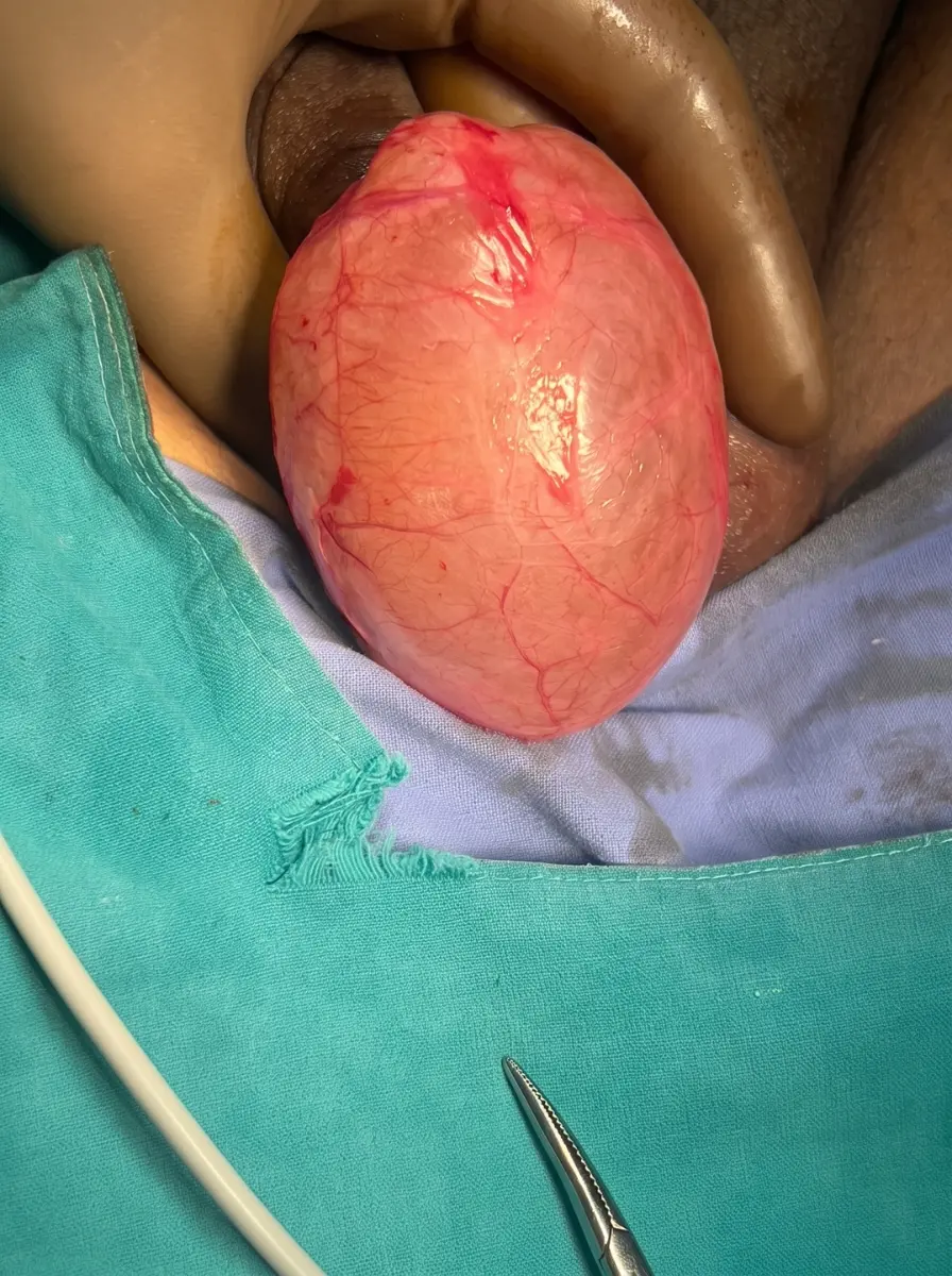 Hydrocele