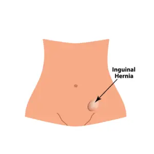Inguinal Hernia