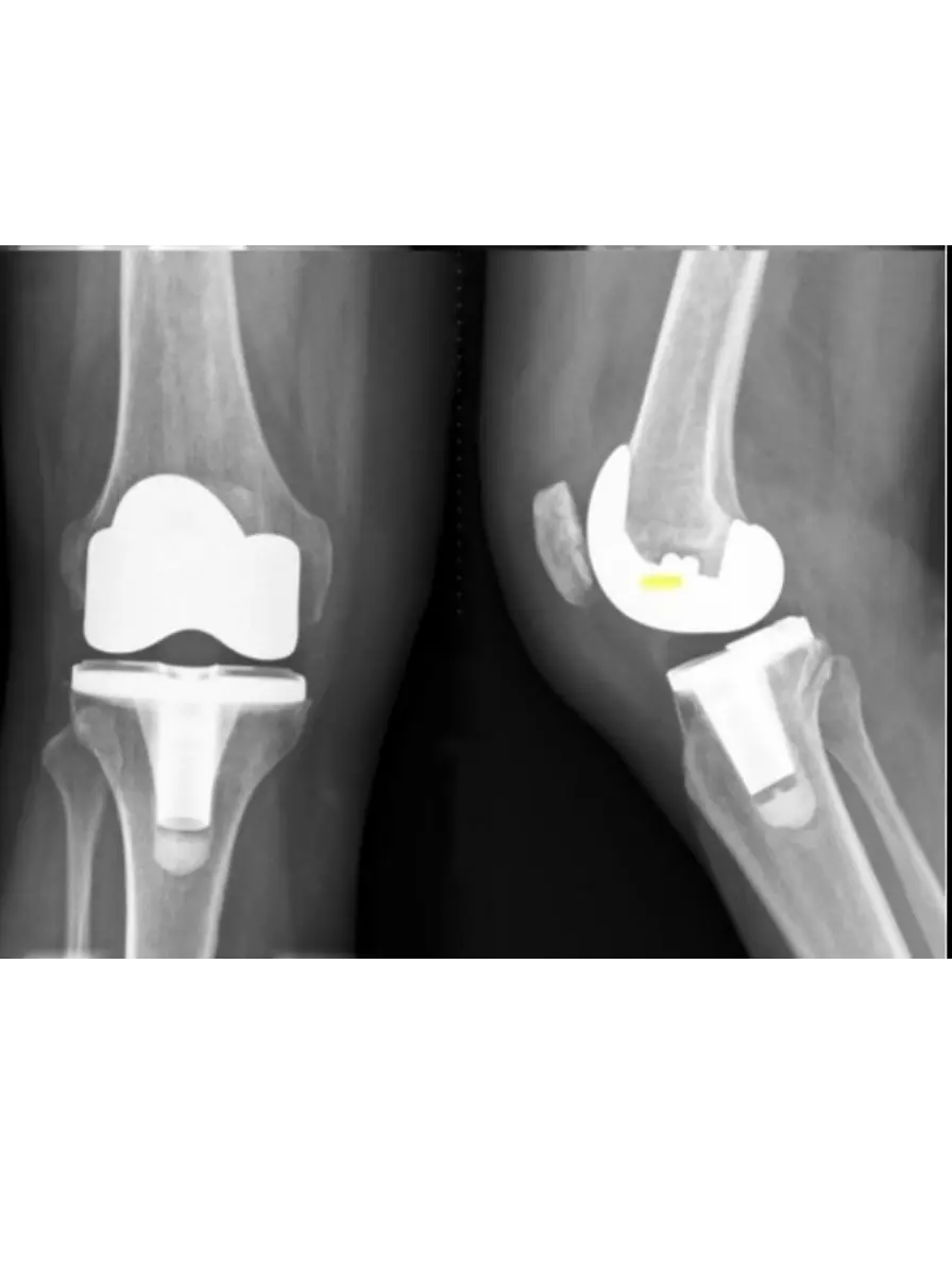 Knee Replacement