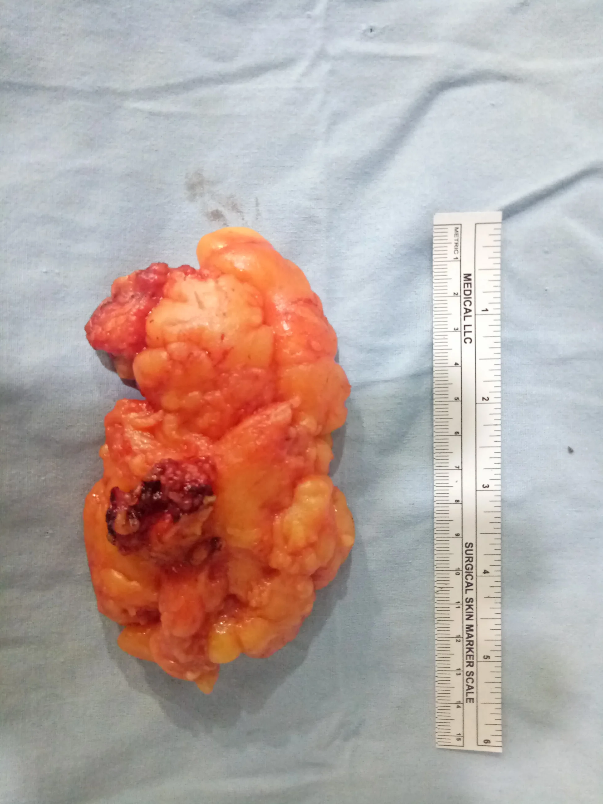 Lipoma