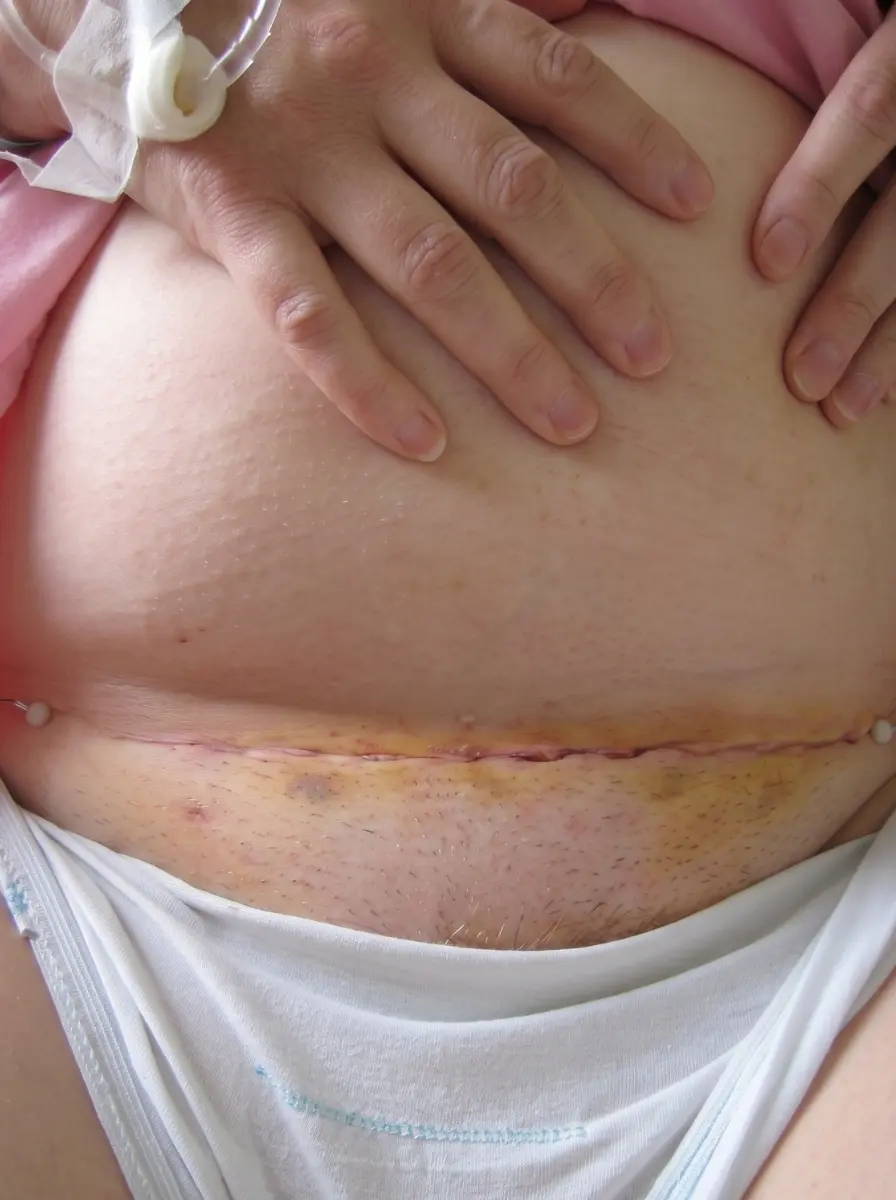 Open Hysterectomy