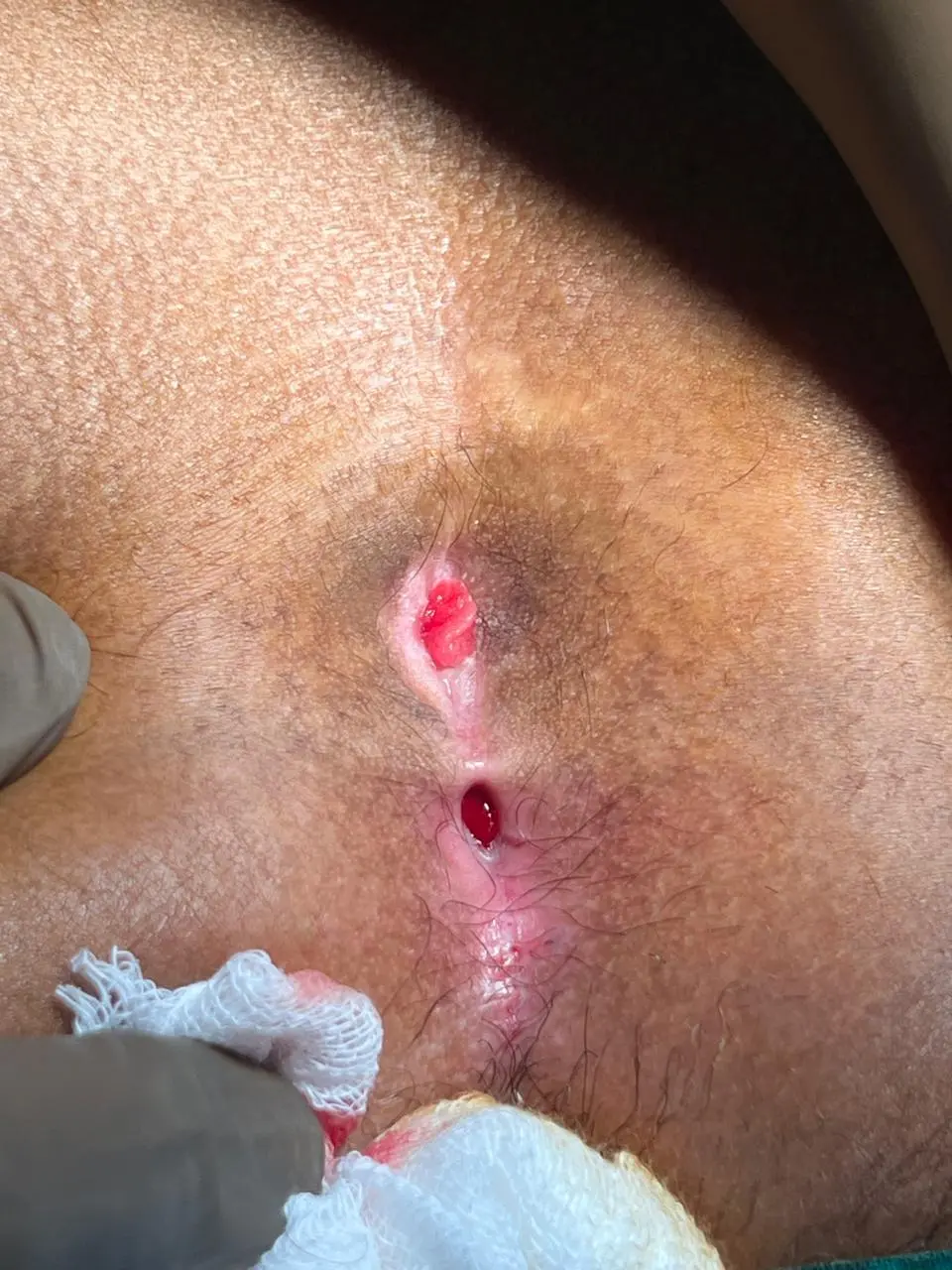 Pilonidal Sinus