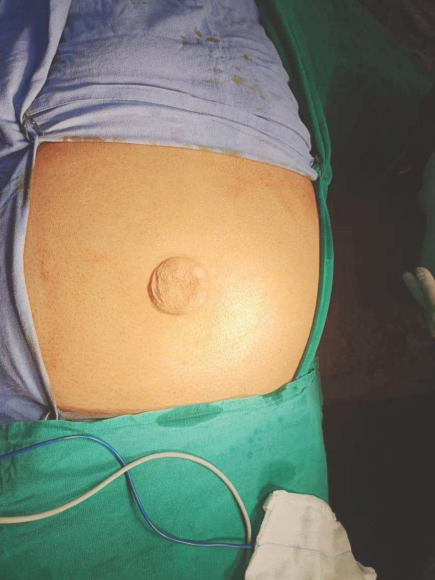 Umbilical