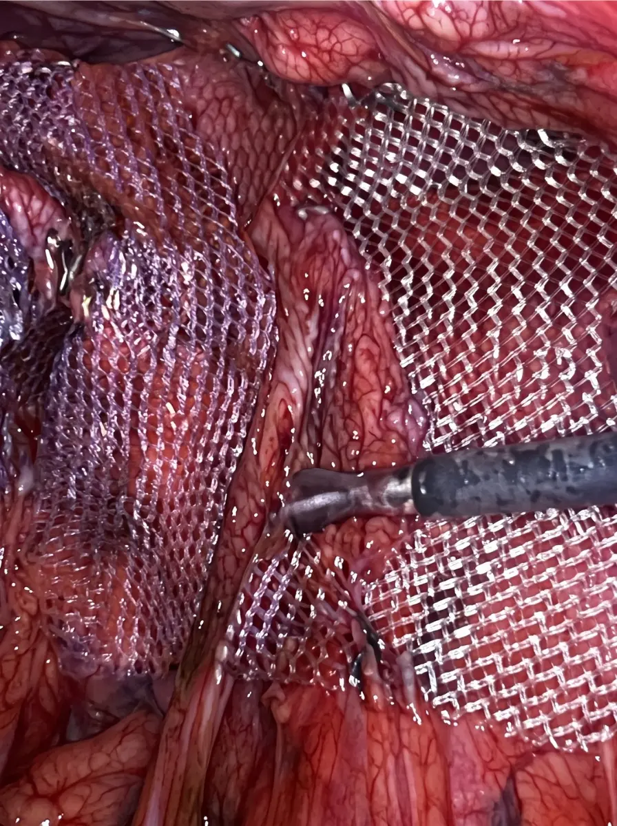 hernia