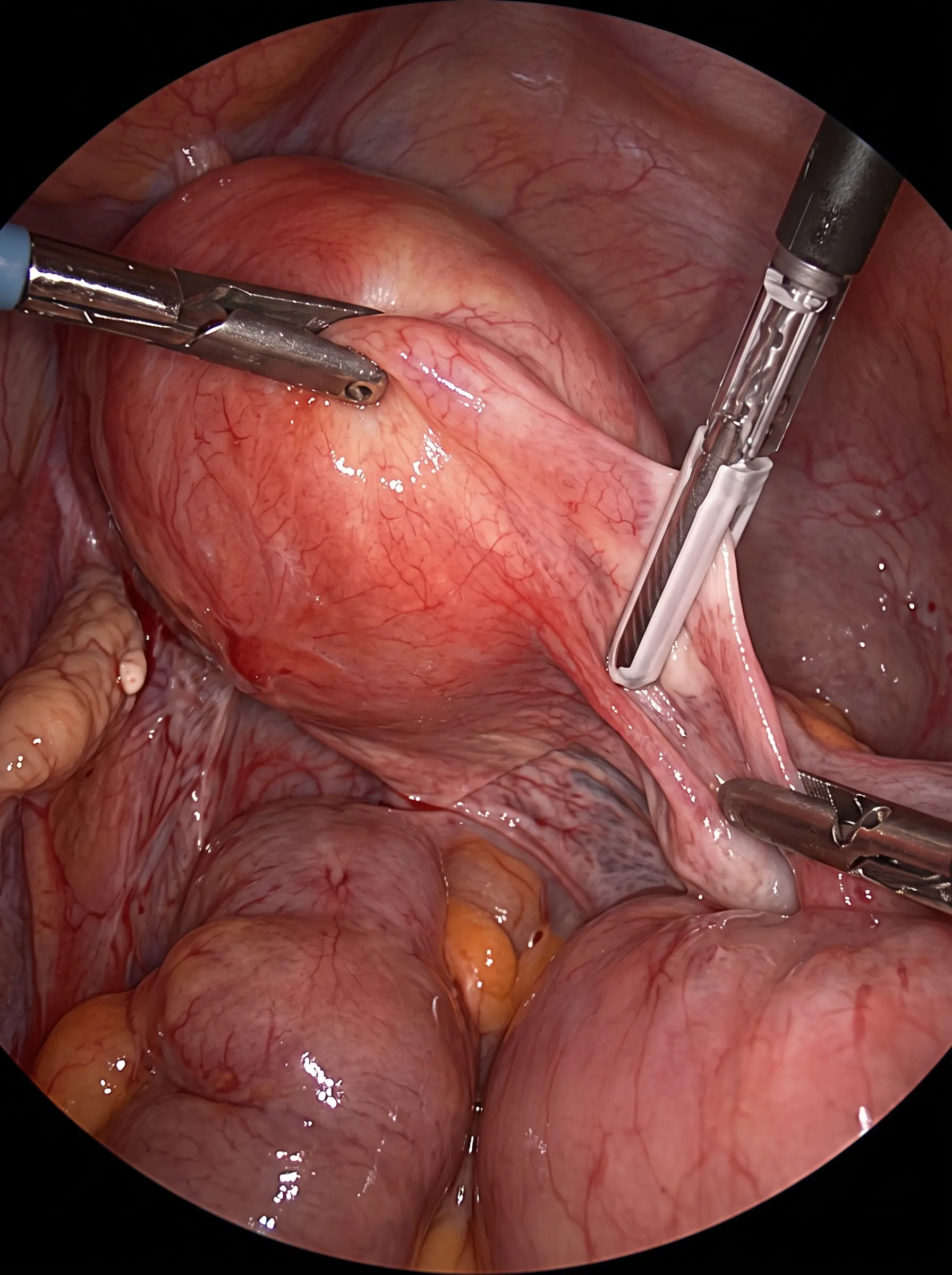 hysterectomy