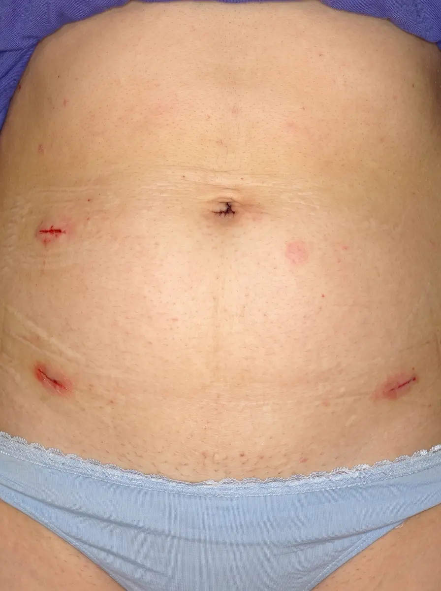 lap hysterectomy