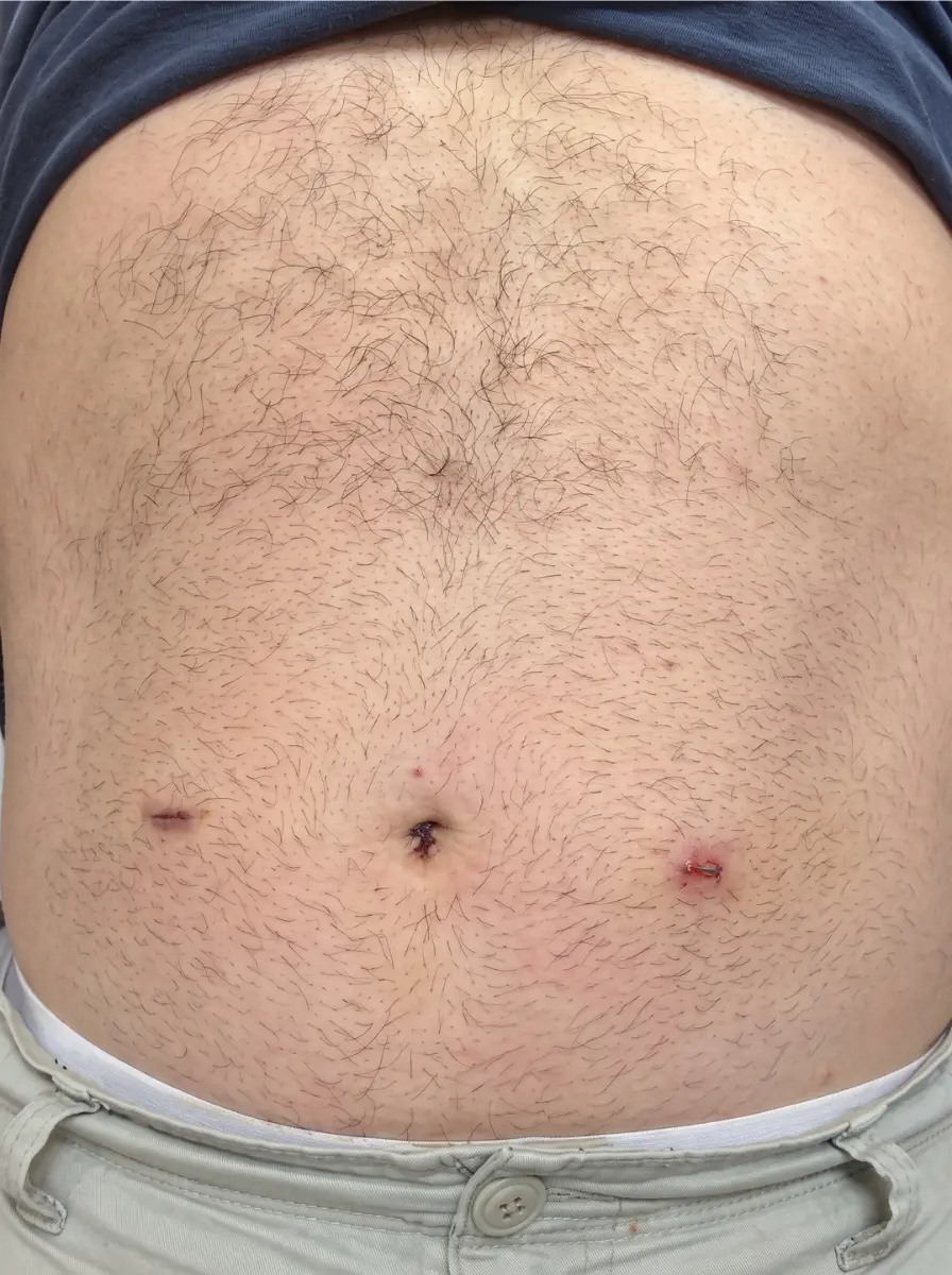 lap inguinal hernia