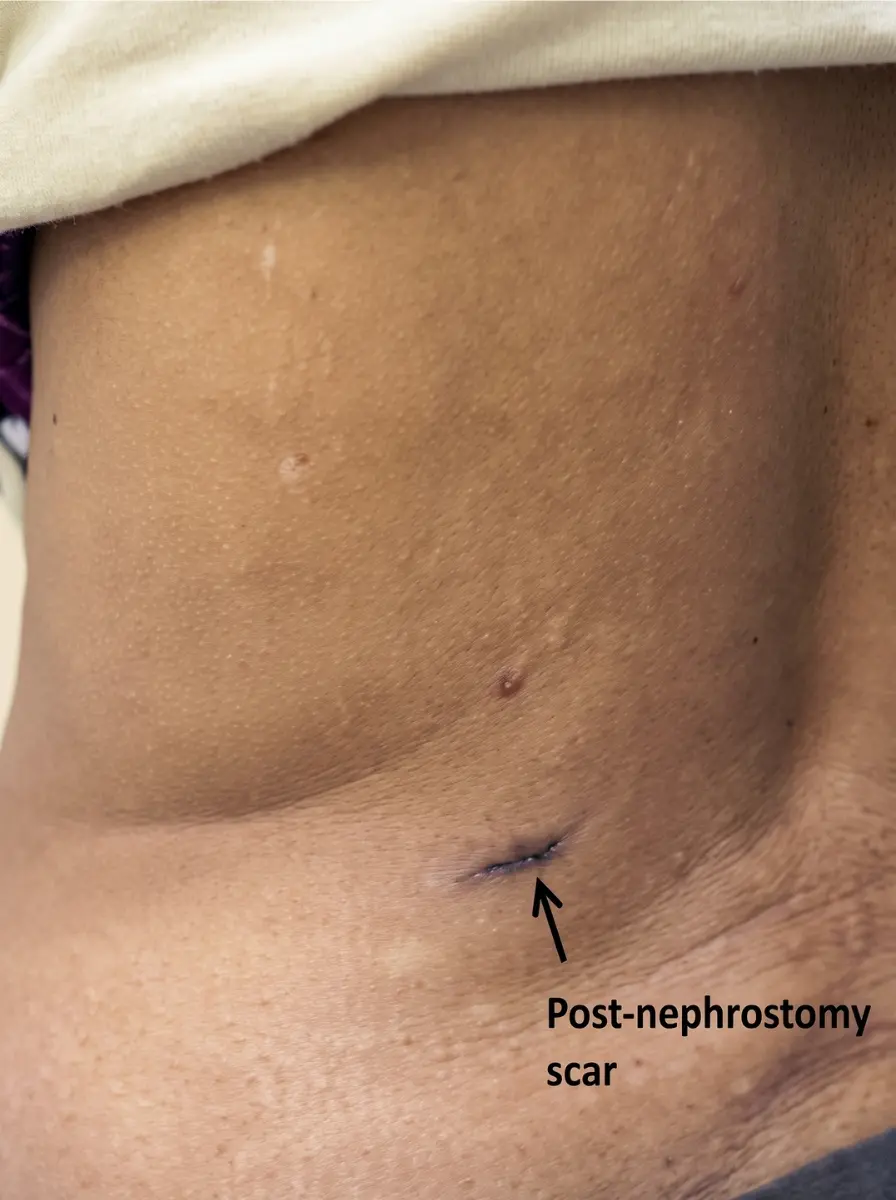pcnl scar