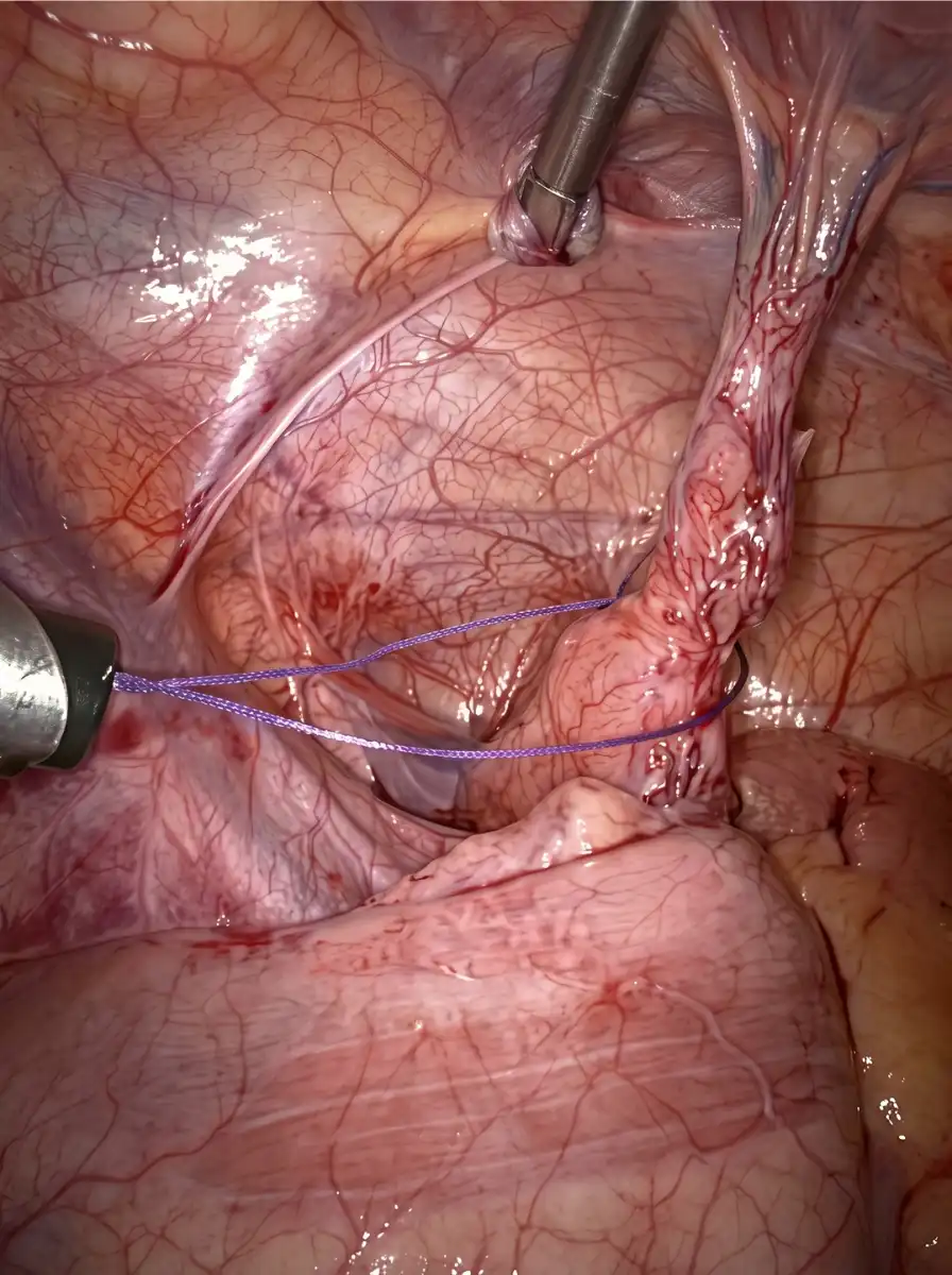 Lap-Appendectomy-1
